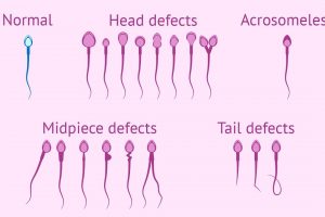 Tìm hiểu về tinh trùng dị dạng ở nam giới